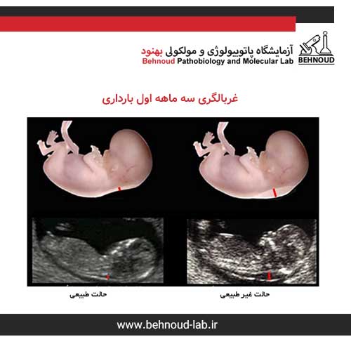 غربالگری سه ماهه اول بارداری 1